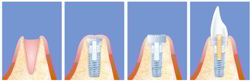 Stages of placing a dental implant to replace a missing tooth at Elmsleigh House Dental Clinic