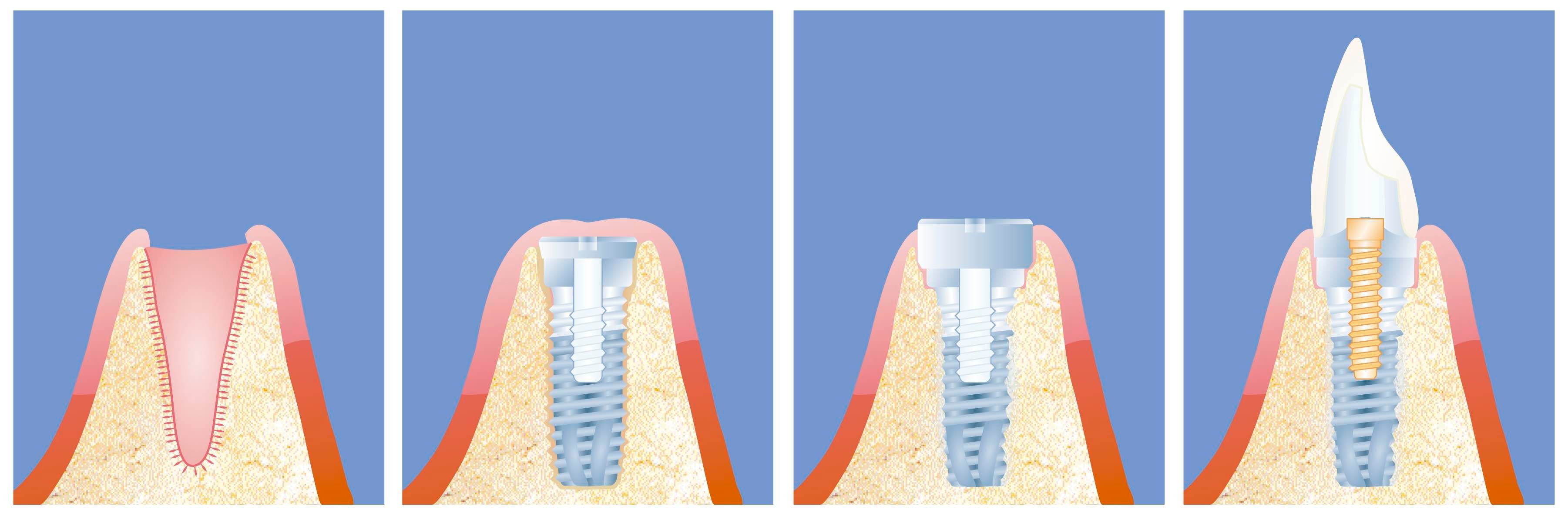 Dental implant - stages