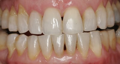 VOS after whitening Invis
