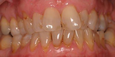 VOS before whitening Invis