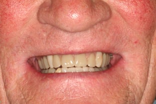 New dentures, cosmetic bonding and a great smile for Mr H!