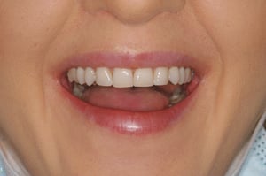 Patient after cosmetic bonding and teeth reshaping at Elmsleigh House