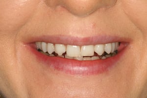 Pt before cosmetic bonding at Elmsleigh House Dental Clinic