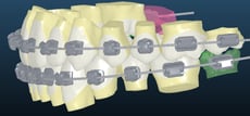 3D model of teeth straightening