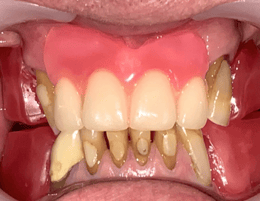 'Try' dentures were placed to show what can be achieved