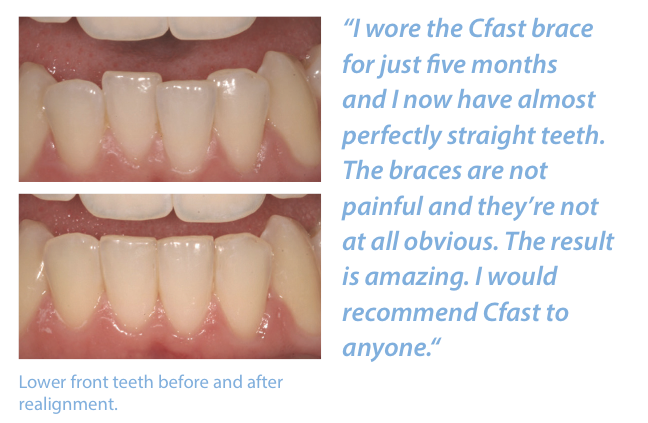 cfast teeth straightening