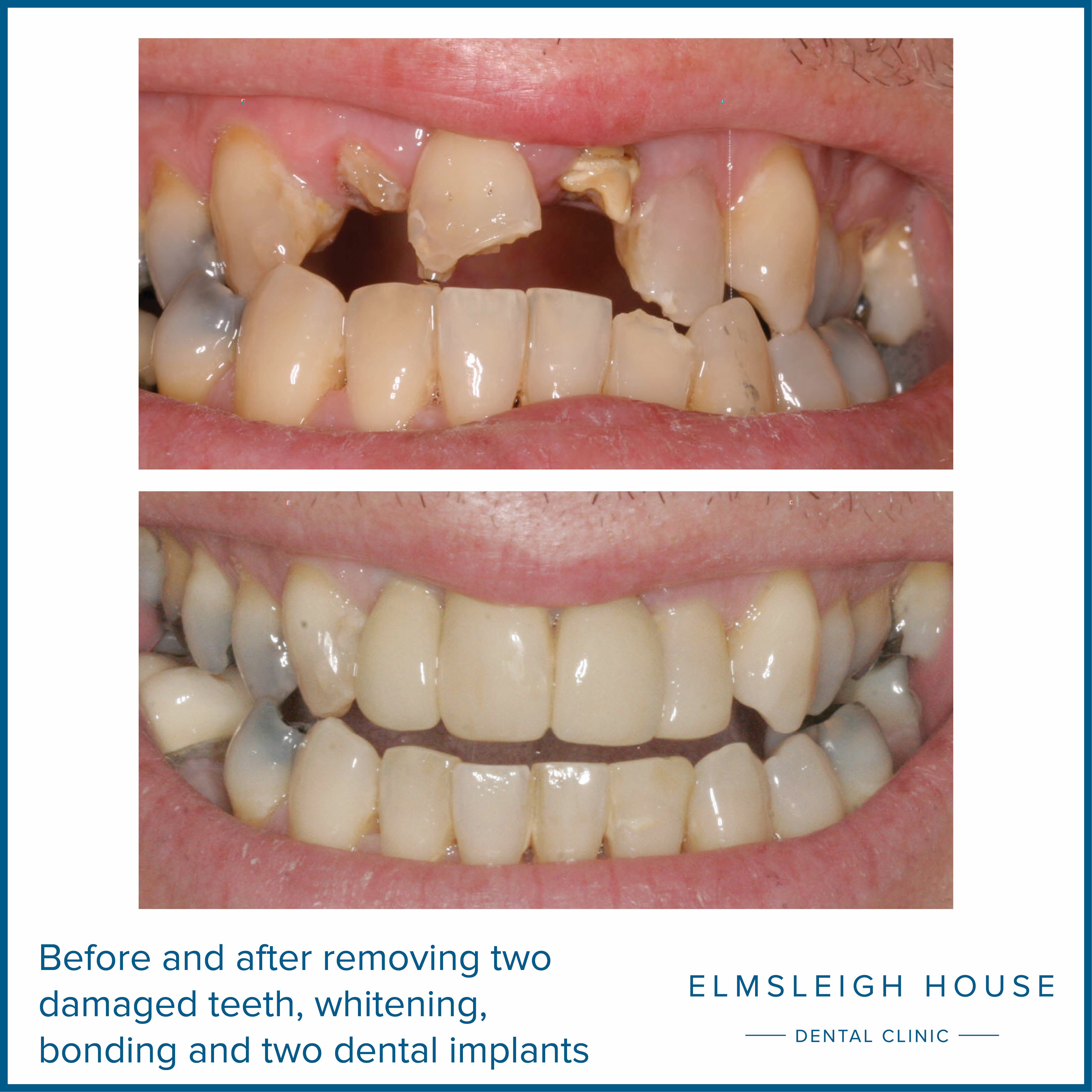 Case Study: Composite Front Teeth Repairs