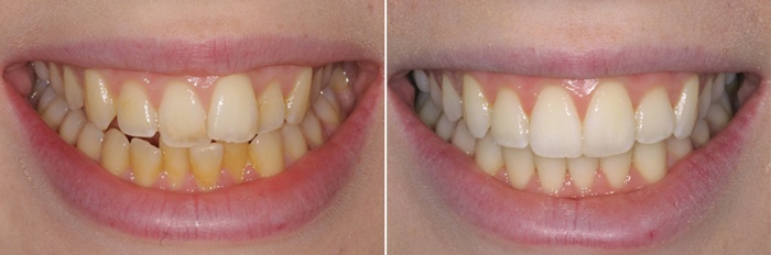 ortho-whitening.jpg